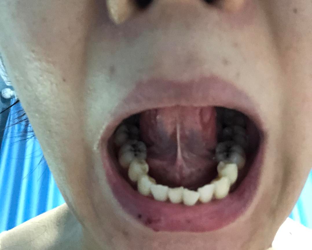 治疗一例咽痛如刀割状、牙痛、唇部疱疹者，一副药未尽剂而愈。