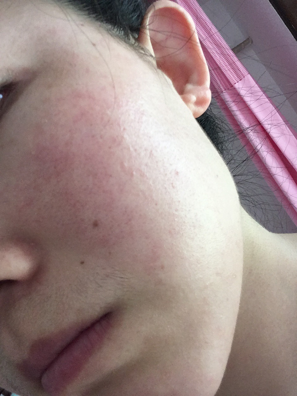 敏感肌长粉刺闭口怎么办,敏感肌发红发痒闭口怎么办