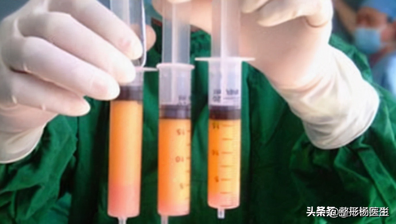 20岁面部凹陷如何改善,脂肪填充面部凹陷怎么导致的呢