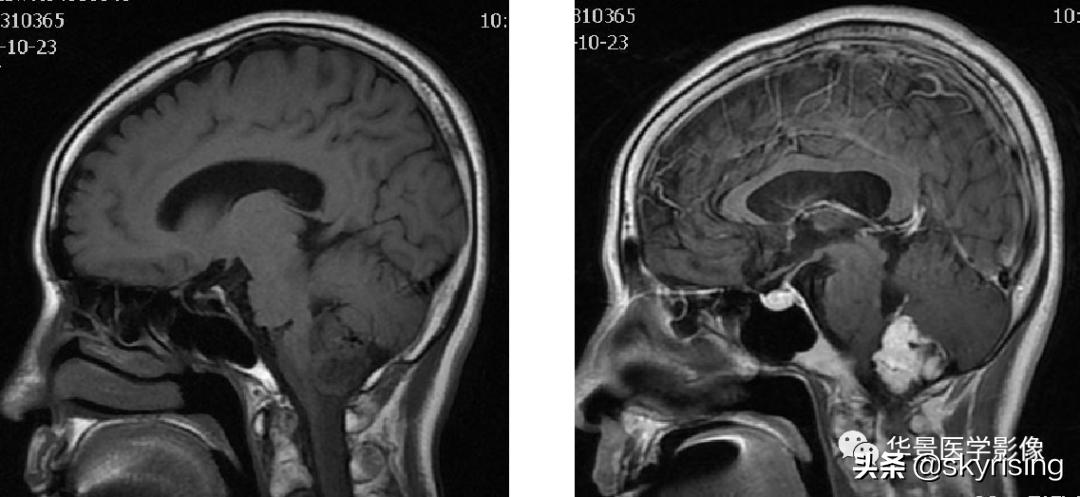 椎体侵袭性血管瘤mri影像学表现,中年妇女脑部血管海绵体瘤的症状