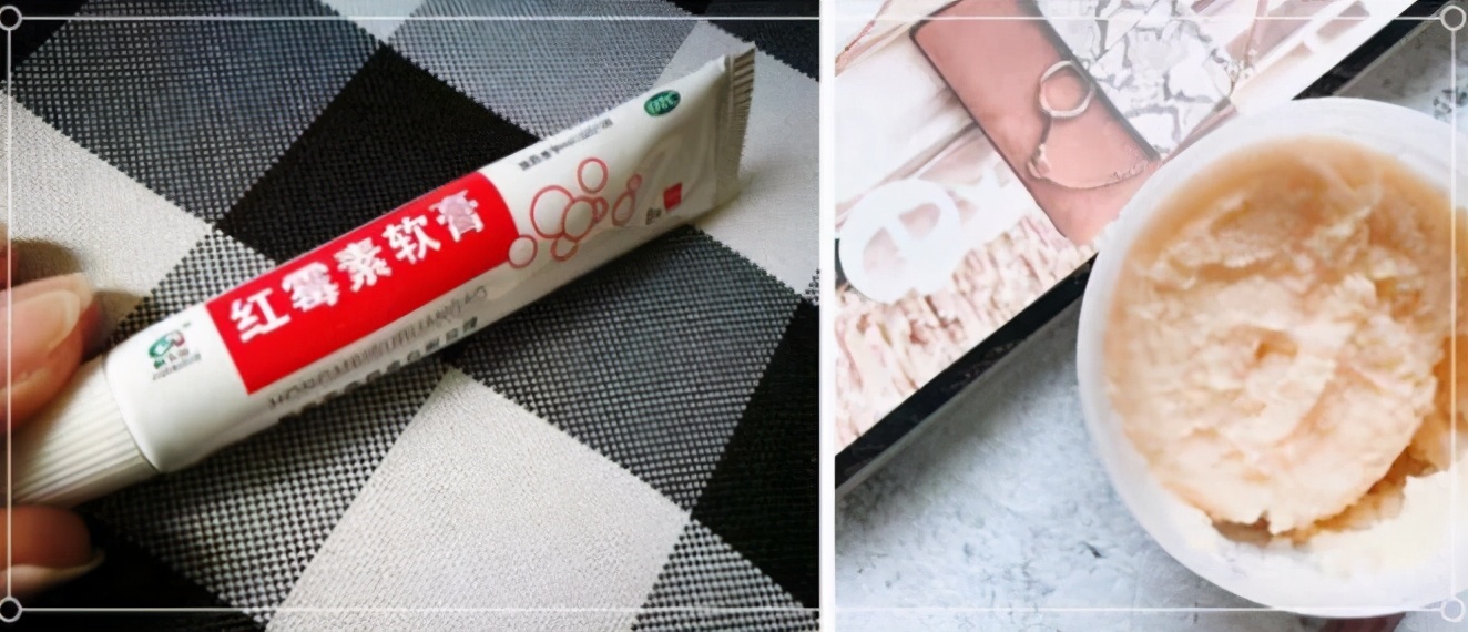 脸上脂肪粒最有效的方法,脸上有脂肪粒怎么办有小妙招