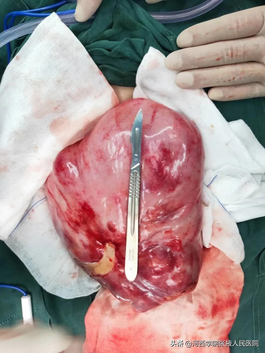 80多岁腹膜后肿瘤,高龄腹腔良性肿瘤手术风险