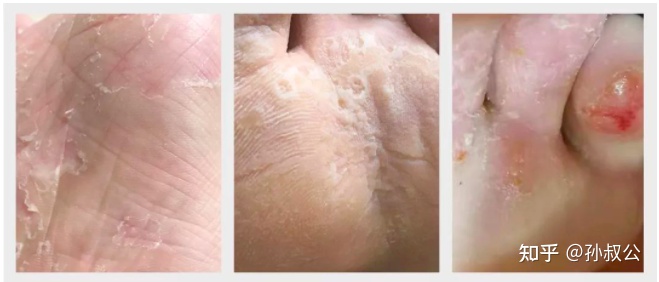 脚气脚臭脚痒的治疗方法小妙招,有脚臭脚痒裂口的脚气症状怎么治