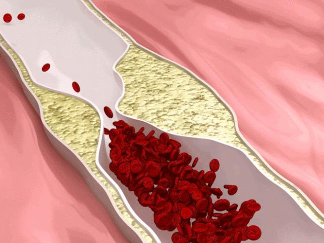 子宫内膜癌的防癌筛查,子宫内膜癌预防与筛查