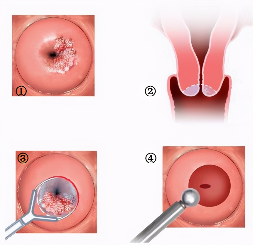 TCT、阴道镜、CIN、锥切(leep)都是什么意思?