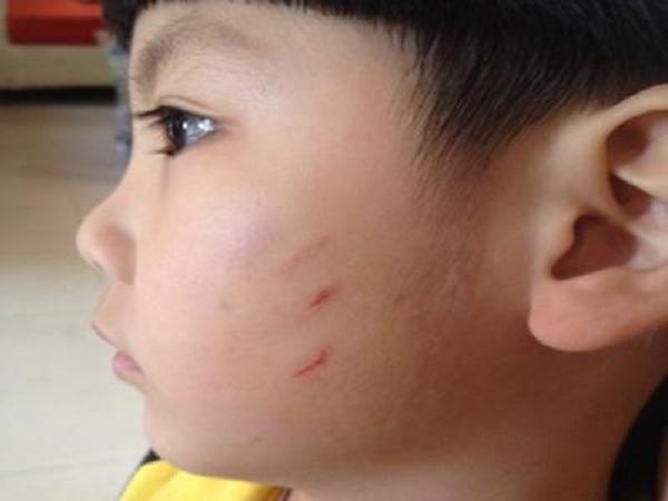 幼儿园孩子脸被抓了咋给家长说,孩子在幼儿园被老师抓烂脸怎么办