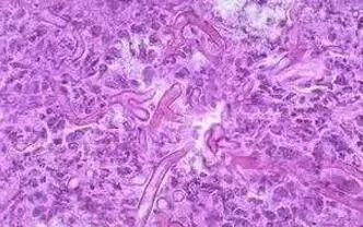 女性有阴道炎要注意什么,女性阴道炎如何才能有效的预防呢