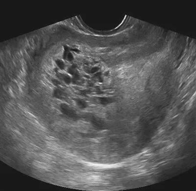 怀孕葡萄胎怎么知道是恶性的,警惕孕期杀手之葡萄胎你得这样做