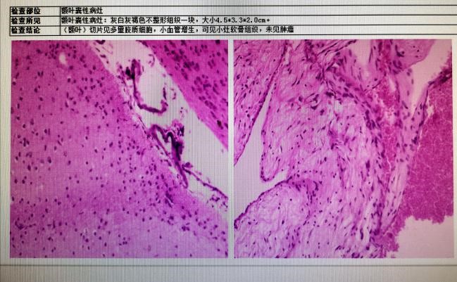 三叉神经痛需要抗癫痫治疗吗,癫痫引起的三叉神经痛怎么治疗
