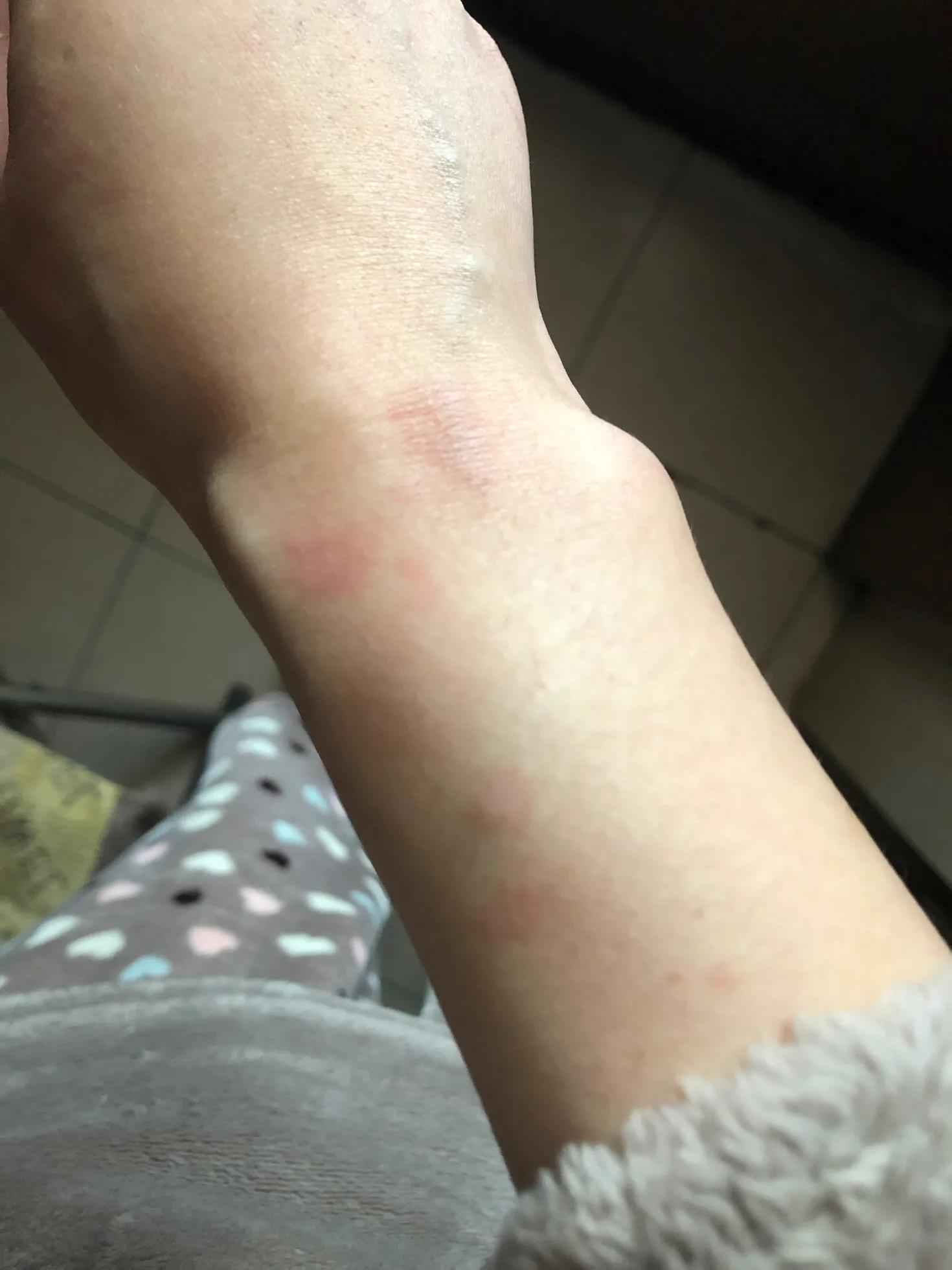 疫情期间低温烫伤的水泡怎么处理,烫伤后二十二天基本都平了