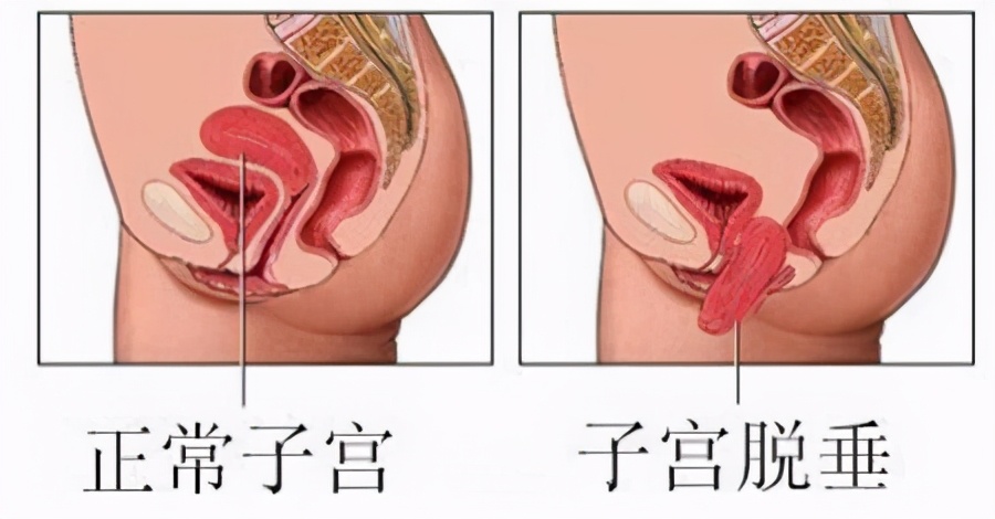 宝妈产后身体修复有哪些,宝妈的产后修复护理是什么