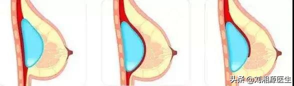 如何知道不良妊娠跟免疫有关系,免疫相关不良妊娠答疑