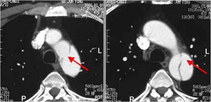 急性心肌梗死的做法,内科主治心肌梗死视频