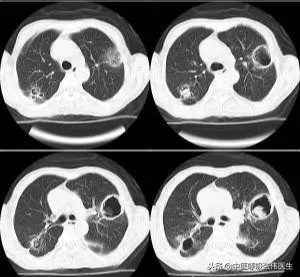 肺曲霉菌病症状,肺曲霉菌病必须手术吗