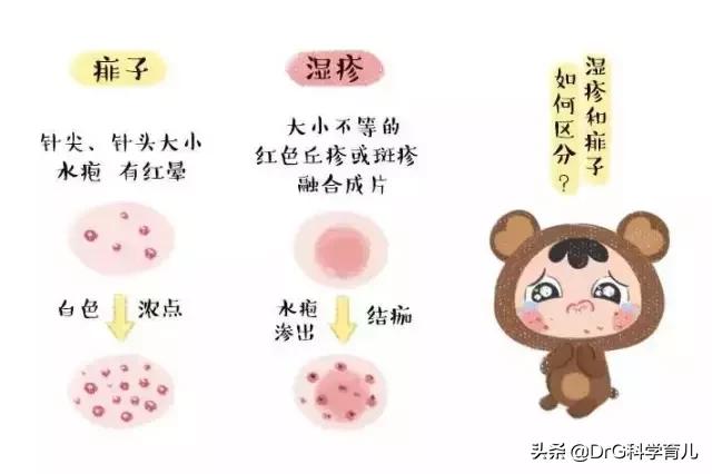 干湿疹为什么会反复的起呢,各种疹子怎么区分