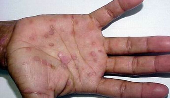 现代梅毒和古代梅毒区别,梅毒古代叫什么