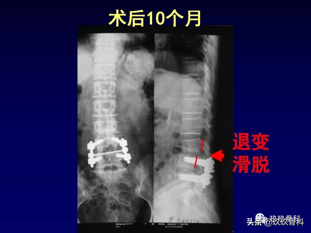 腰椎不稳最坏的结果,腰椎不稳的最佳治疗方法