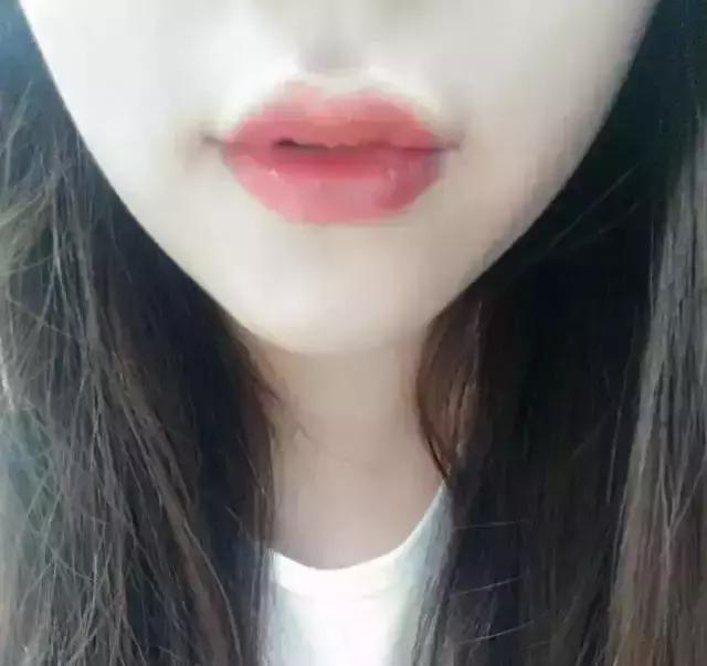 明星注射玻尿酸案例,注射玻尿酸变美