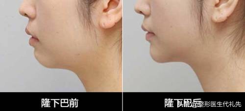 你真的适合隆鼻吗,短下巴适合填充下巴吗