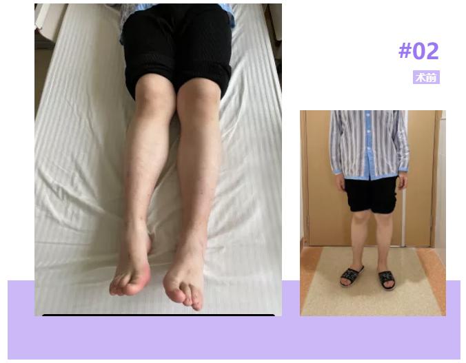 长短腿骨盆倾斜,二郎腿骨盆纠正