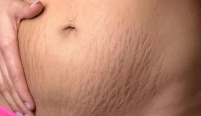 护博士产后妊娠纹修复,产后妊娠纹怎么消除小妙招