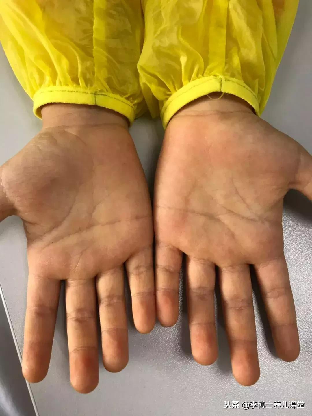 今天接诊了一个手脚皮肤越来越黄的孩子，我却让她回去了！