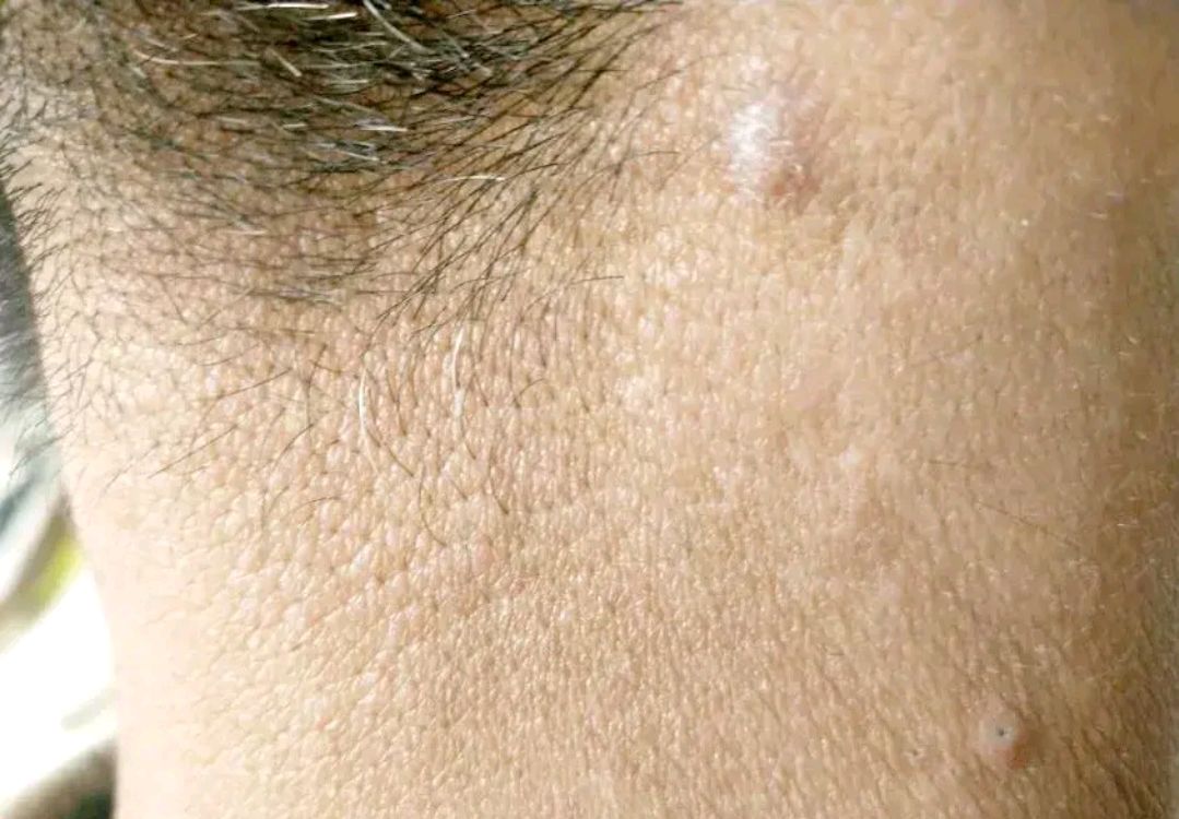 神经性皮炎裹保鲜膜可以吗,神经性皮炎治不好