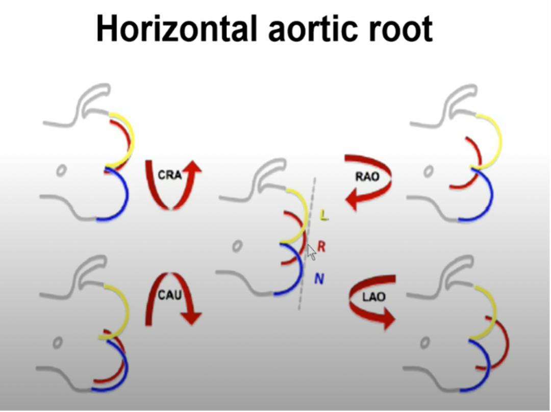 对造影剂过敏如何进行介入治疗,造影剂过敏迟发性治疗