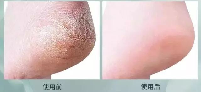 冬天手脚粗糙开裂小妙招,冬季手脚干裂怎么快速修复