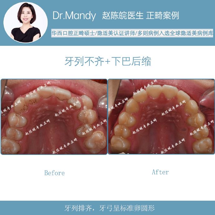 杭州牙齿隐形矫正,杭州成人隐形矫正牙齿优惠