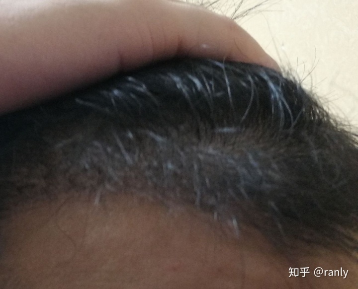 植发日记是什么,植发日记vlog第六天