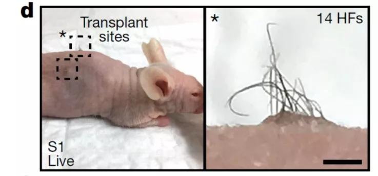 脱发治愈研究,困扰当代年轻人的脱发