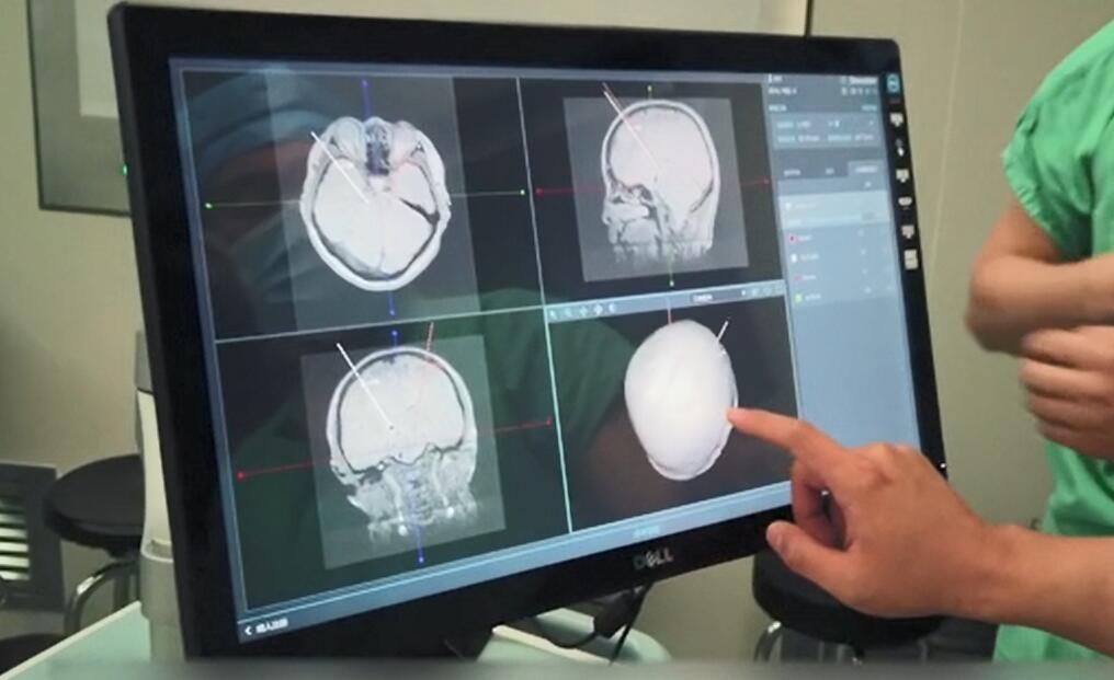 帕金森病治疗的最新最好方法,国内治疗帕金森病著名专家