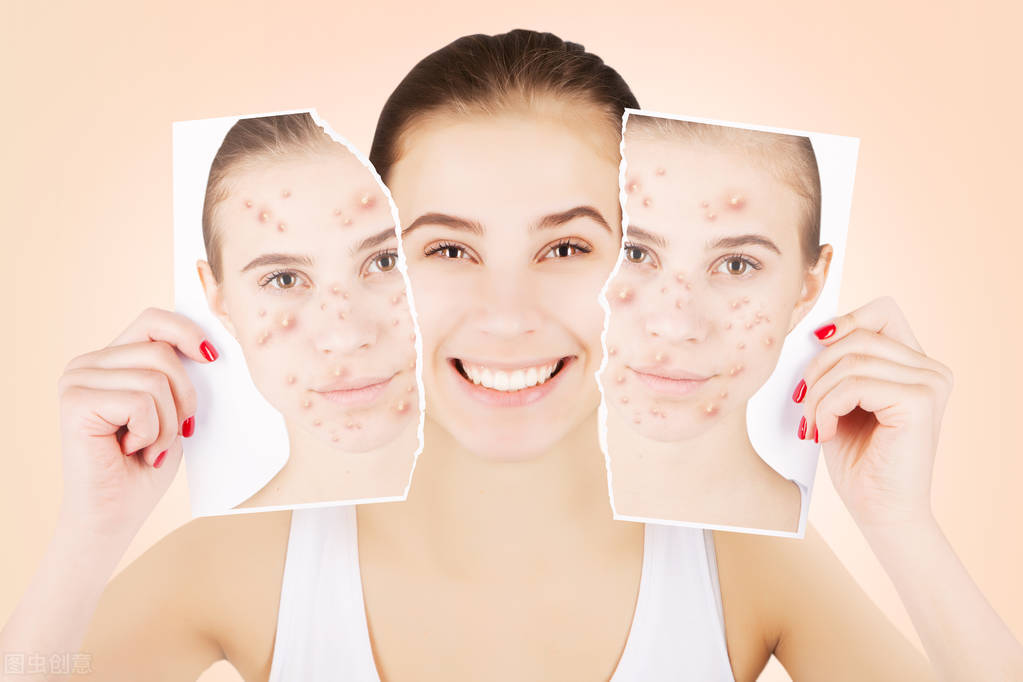 怎样护理皮肤祛痘,怎么快速祛痘养成好皮肤