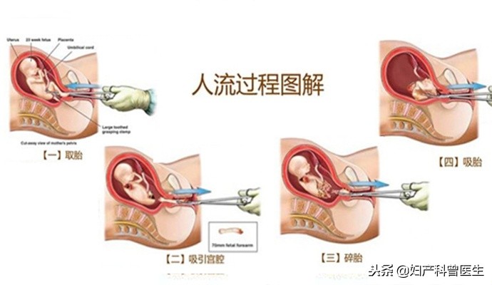 傻姑娘，别再拿人流开玩笑，子宫经不起你这样的“折腾”