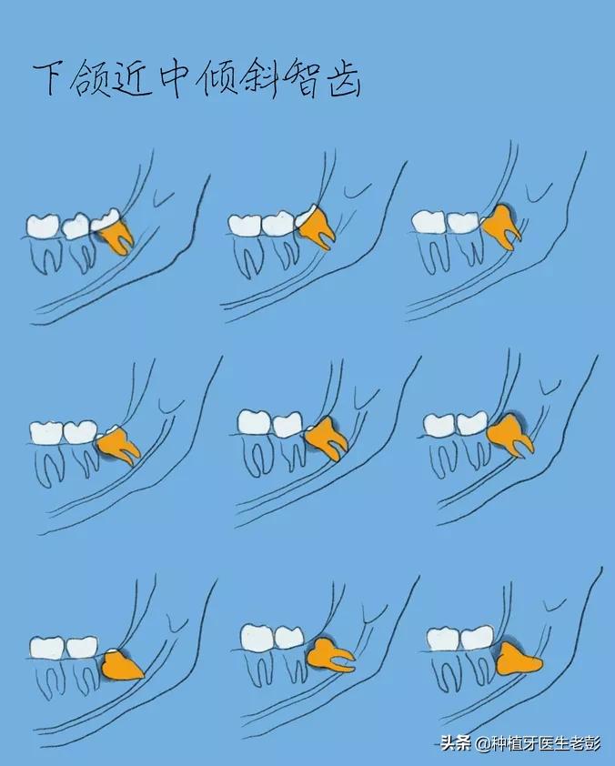 智齿发炎真是疼啊,为什么智齿发炎了会反反复复