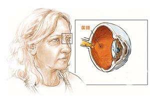 手机上的5g毫米波是什么,5g手机导致眼睛失明