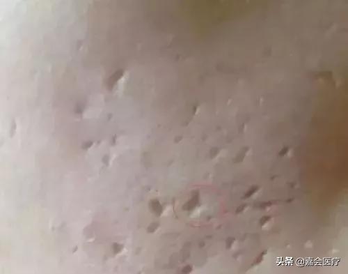 反反复复的痘痘涂什么药膏,反反复复痘痘痘印怎么祛除