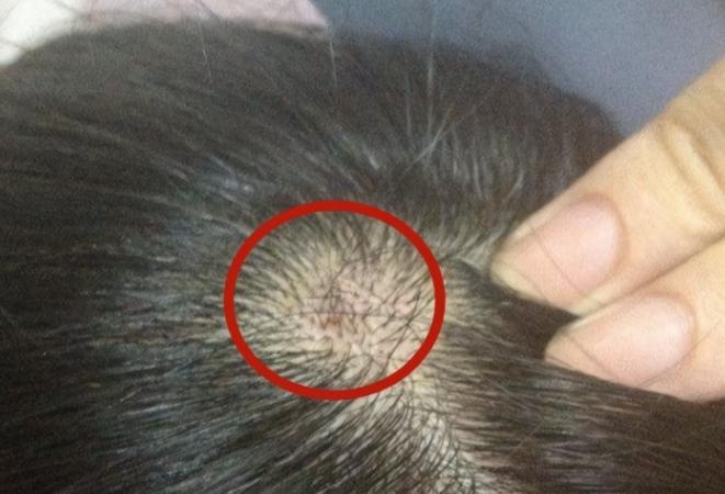 头皮长小疙瘩抠破有脓怎么办,头皮长了个疙瘩破了怎么办