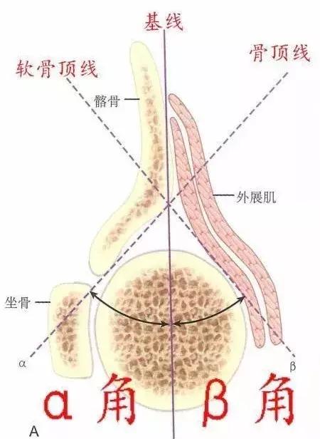 宝宝大腿纹不对称，要做哪些检查？