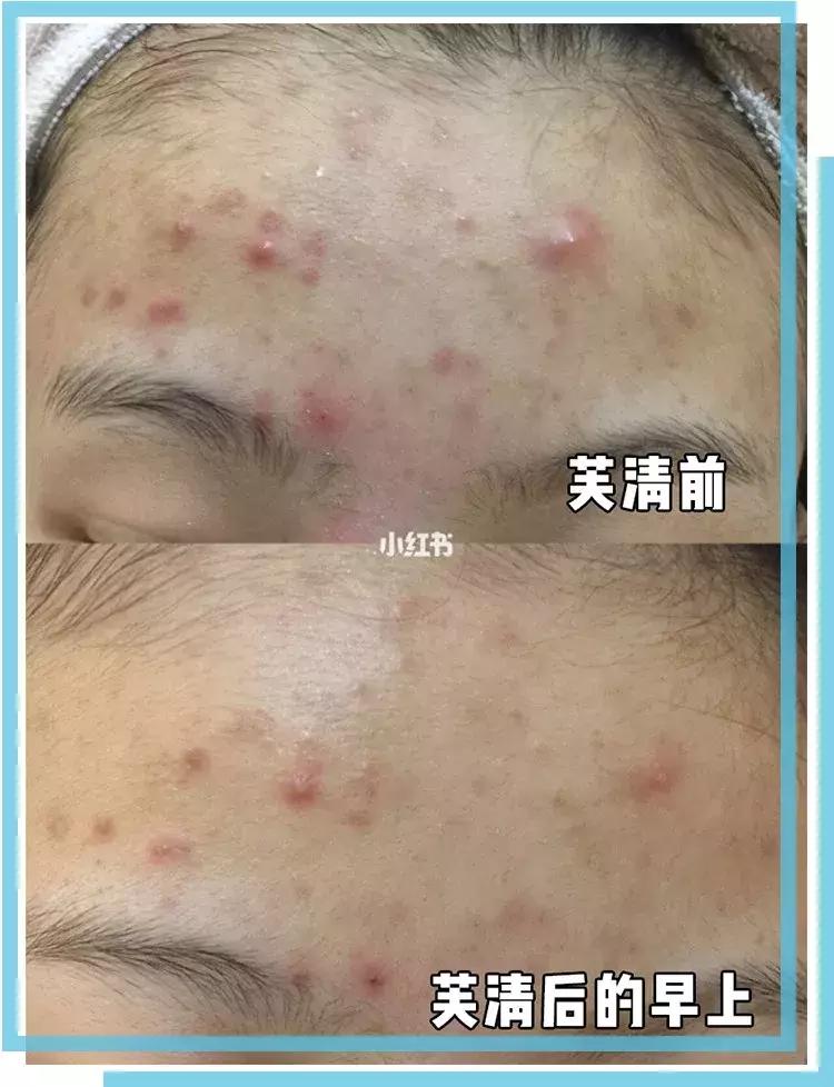 如何有效的祛痘印医美面膜,消炎祛痘的医美面膜