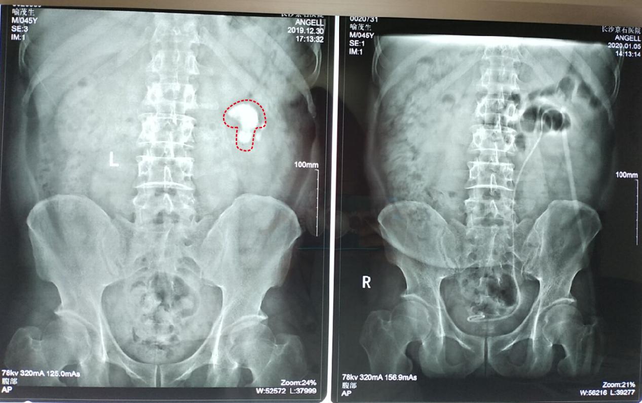 43岁男子腰痛以为肾结石,男子腰部隐隐作痛一查竟是肾结石