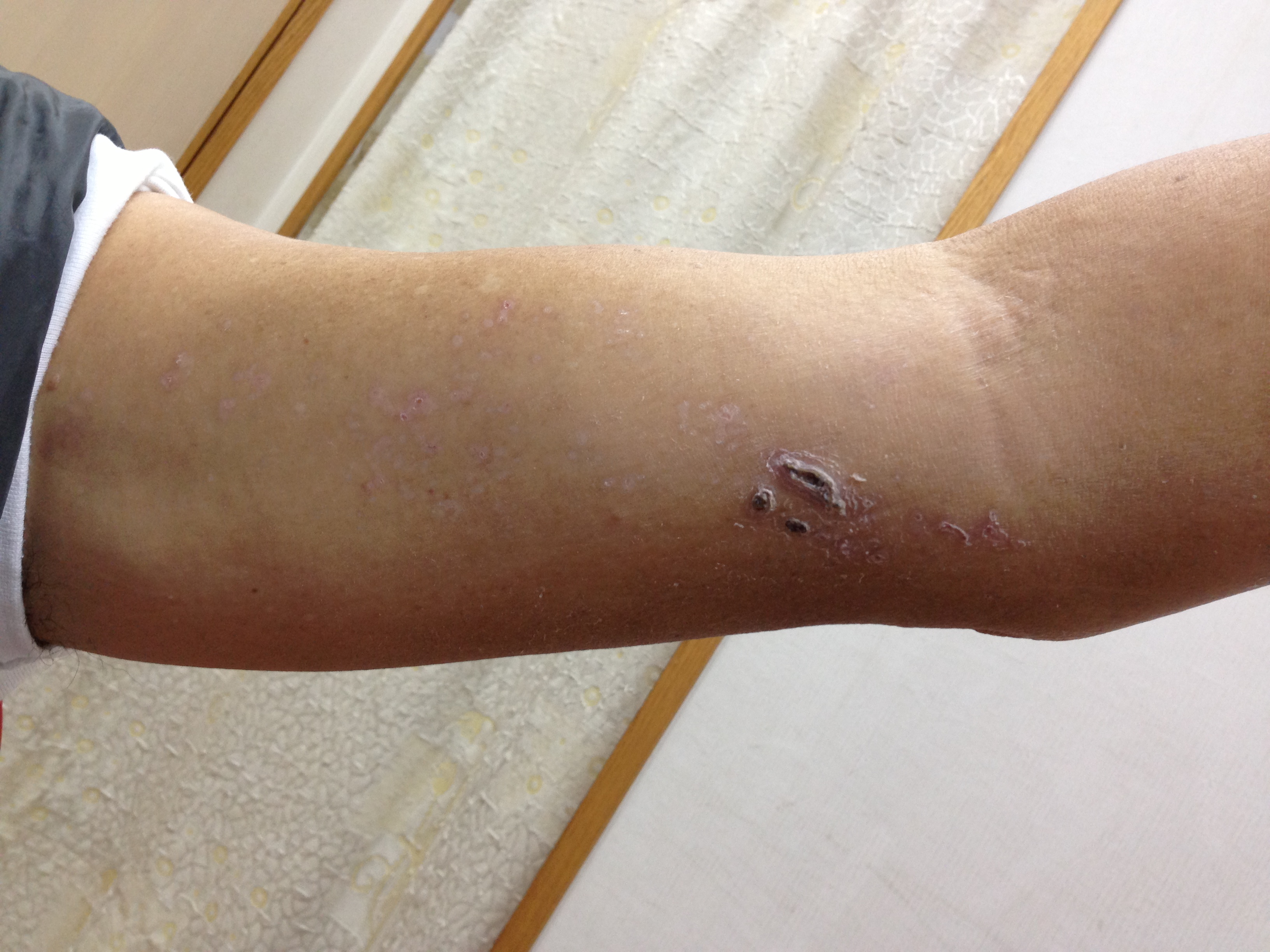 门诊日记全集,带状疱疹入院记录范文