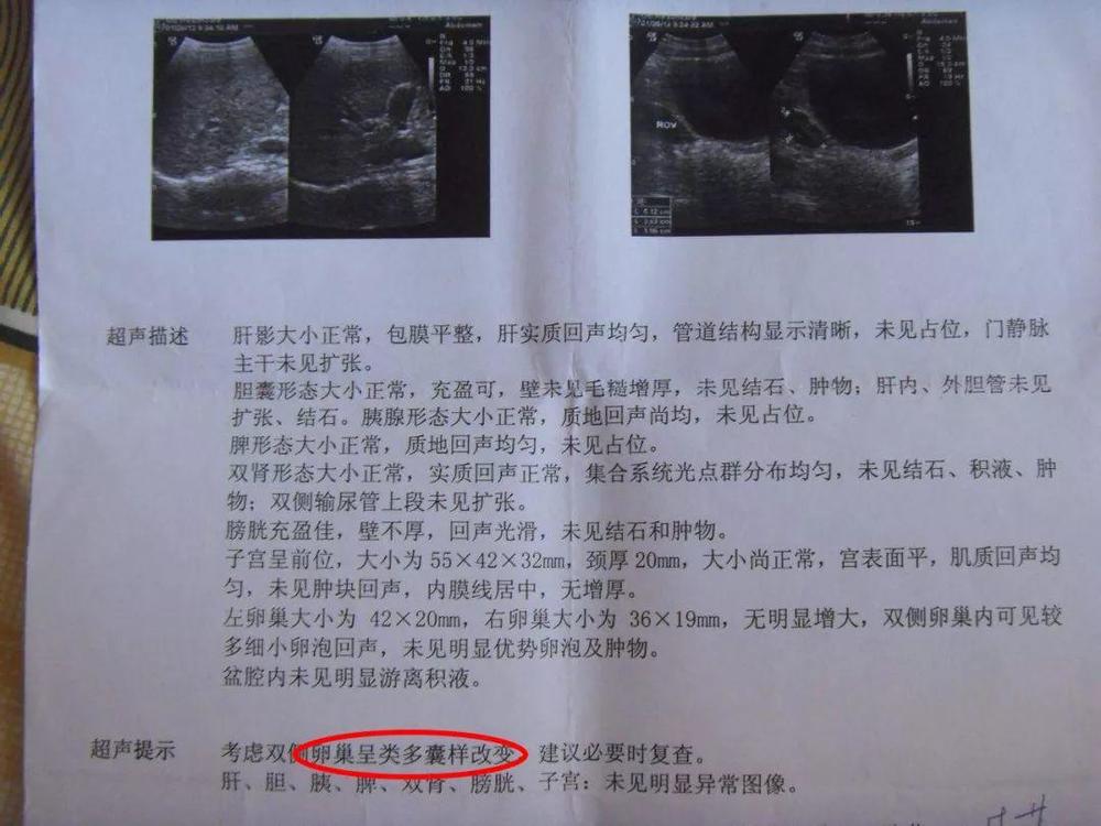 B超出现“卵巢多囊”4个字,就一定是多囊卵巢综合征?该怎么办?