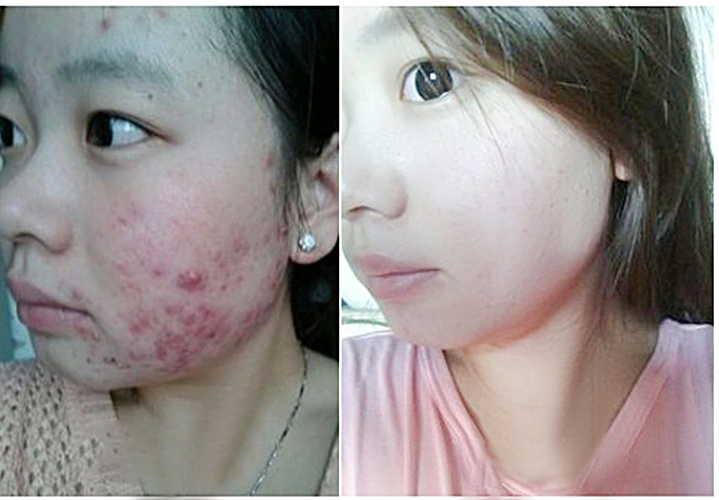青春痘如何快速消除盘点祛痘招数,青春痘怎样才能快速消除小妙招