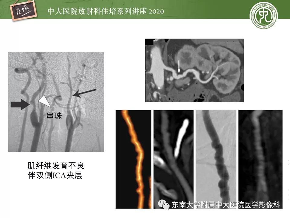 颈动脉夹层的超声表现及漏诊分析,动脉夹层与夹层动脉瘤是一样的吗