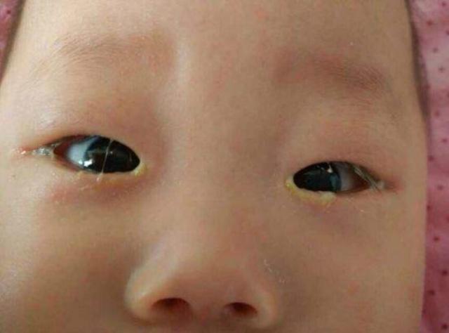 刚满月宝宝眼睛有眼屎还流泪,刚满月的小孩一只眼老长眼屎
