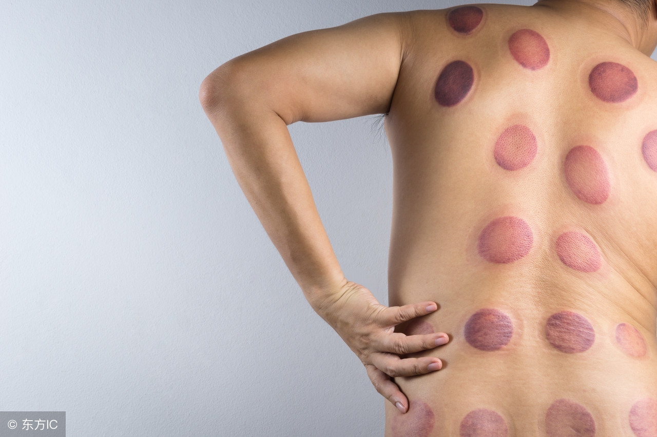 拔罐的知识与视频解说,拔罐后的罐印代表什么你知道吗