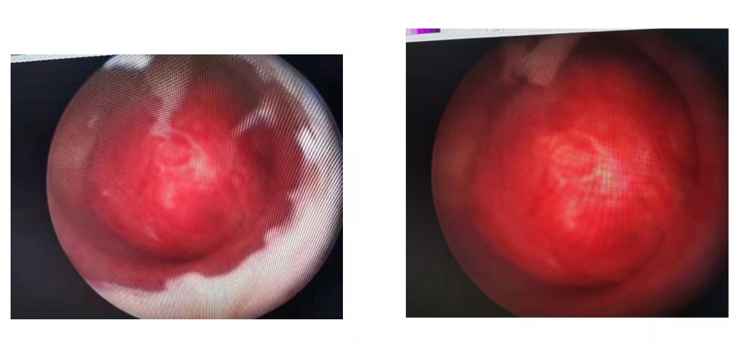 紧跟医学前沿三亚中心医院成功开展宫腔镜刨削系统手术为90后未婚女性摘除粘膜下肌瘤