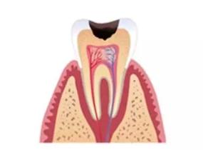 五岁小孩牙齿蛀了需要补吗,门牙边上的牙齿蛀了能补吗